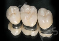 Dental Crowns