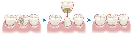 Crown Procedure