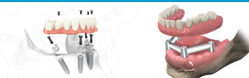 Dental Implants