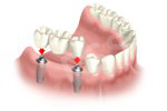 Implant bridge