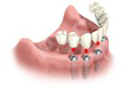 Implant Fixed Bridge