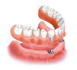 Implant Overdentures