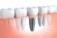 Tooth Implant