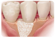 Bone Grafting