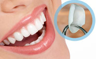 Porcelain Veneers