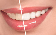 Composite Veneers