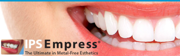 IPS Empress Esthetics Veneers